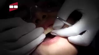 لمینیت سرامیکی قسمت 1 | کلینیک دندانپزشکی مهر زعفرانیه
