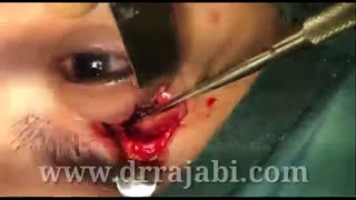 ضایعه استخوانی سقف کاسه چشم