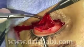 رترکشن یا بالارفتن پلک بالا با عمل جراحی مولر رزکشن