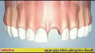 فیلمی از کاشت ایمپلنت دندان