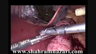 خارج کردن بالن معده و اسلیو گاسترکتومی لاپاروسکوپیک