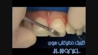 ترمیم دندان توسط متخصص دندانپزشکی ترمیمی