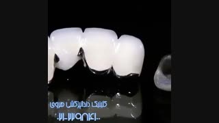 مواد کامپوزیتی جایگزین آمالگام برای ترمیم دندان