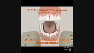 ارتودنسی دندان روکش شده