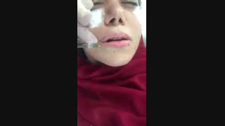 تزریق ژل لب جهت برجسته سازی و اصلاح فرم لب ها