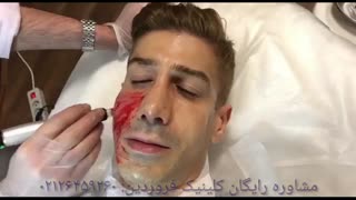 جوانسازی پوست با میکرونیدلینگ