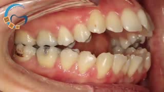 ارتودنسی اپن بایت با جراحی فک | دکتر مسعود داوودیان