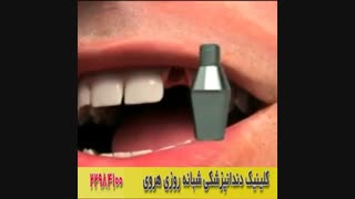 ترمیم دندان شکسته جلو با ایمپلنت