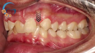 ارتودنسی کراس بایت و دیپ بایت شدید | دکتر مسعود داوودیان