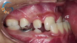 ارتودنسی با استفاده از فیس ماسک | دکتر مسعود داوودیان