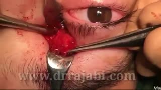 جراحی تومور بزرگ کاسه چشم در کودک ١٤ساله