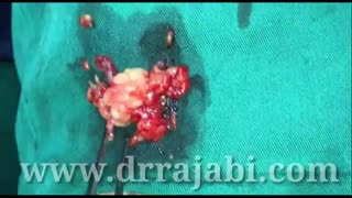 اصلاح بیرون زدگی چشم ناشی از تیروئید