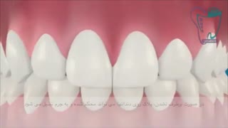 پلاک دندانی | سیمادنت