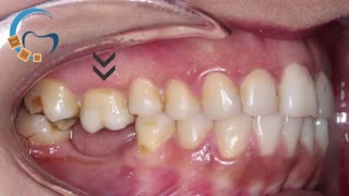 ارتودنسی با استفاده از مینی اسکرو | دکتر مسعود داوودیان
