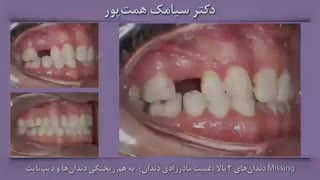 درمان به وسیله تری‌های شفاف - دکتر سیامک همت پور متخصص ارتودنسی رفع چین و چروک