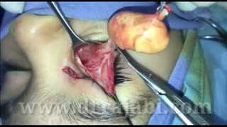 تومور بزرگ مادرزادی در محلی غیرطبیعی در کودک چهارساله