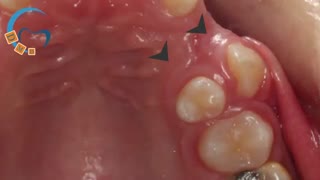 ارتودنسی ترنسپزیشن (جابه‌جایی دندان‌ها) | دکتر مسعود داوودیان