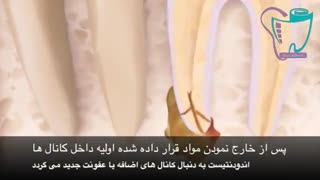 عصب کشی مجدد دندان | سیمادنت