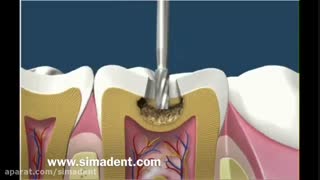 مقایسه آمالگام و کامپوزیت | سیمادنت