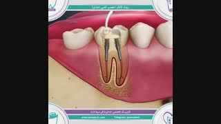 روت کانال ( عصب کشی ) | دندانپزشکی  سیمادنت