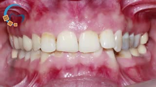 ارتودنسی دیپ بایت | دکتر مسعود داوودیان