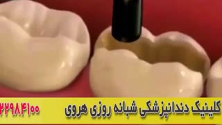 ترمیم دندانها با اینله و آنله دندان