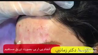 جوانسازی صورت با پی آر پی PRP میکرونیدلینگ