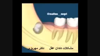 چرا دندان عقل کشیده می شود ؟