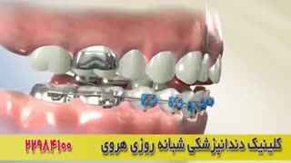 از مشکلات ارتودنسی و براکت ارتودنسی دندان + راه حل این مشکل