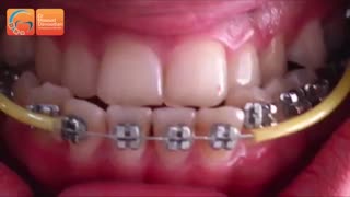 جراحی فک بدون ارتودنسی | دکتر مسعود داوودیان