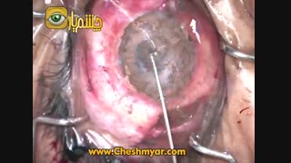 شکوه شیخی پور ، مدرس اسکراب نرس چشم پزشکی