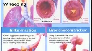 صداهای غیر عادی ریه در معاینات + ویدئو آموزشی