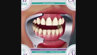 بلیچینگ - سفیدکردن دندان | دندانپزشکی سیمادنت جراحی فک