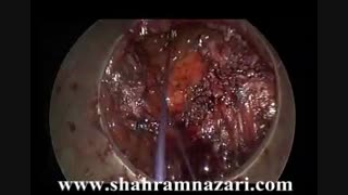 عمل جراحی برداشتن پولیپ از روی آناستوموز عمل قبل (آیا سابقه عمل قبلی مهم است؟)