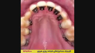 دندان مرتب با ارتودنسی دندان