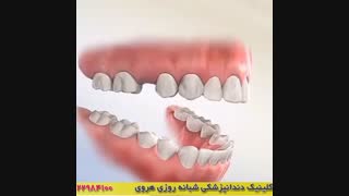 درمان جلو بودن فک اتوپلاستی