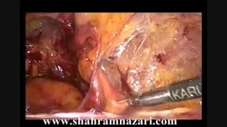 نحوه عمل جراحی ترمیم فتق کشاله ران با دوختن حلقه فتق