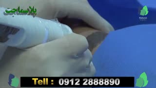 برداشتن ماه گرفتگی - پلاسماجت دکتر پوست
