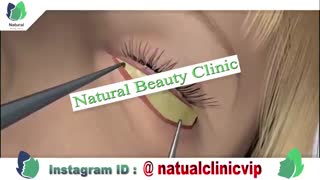 برطرف کردن افتادگی پلک