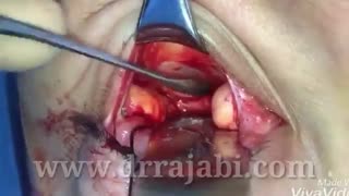 اصلاح بیرون زدگی چشم در زمینه ی تیروئید چشمی