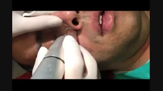 جوانسازی و از بین بردن لک صورت - 22807060 ترمیم زیبایی دندان