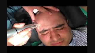 جوانسازی و از بین بردن لک صورت - 22807060 تزریق چربی