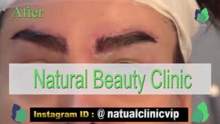 نمونه کار کاشت ابرو- قبل و بعد از کاشت!- نچرال بیوتی