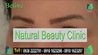 نمونه کار کاشت ابرو- قبل و بعد از کاشت!- نچرال بیوتی