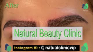 نمونه کار کاشت ابرو- قبل و بعد از کاشت!- نچرال بیوتی