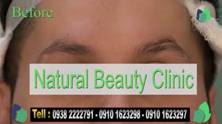 نمونه کار کاشت ابرو- قبل و بعد از کاشت!- نچرال بیوتی