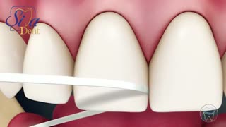 شیوه صحیح استفاده از نخ دندان | دندانپزشکی سیمادنت