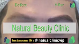 نمونه کار کاشت ابرو- قبل و بعد از کاشت !!!- نچرال بیوتی