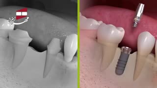 انیمیشن بریج و ایمپلنت | کلینیک دندانپزشکی مهر زعفرانیه