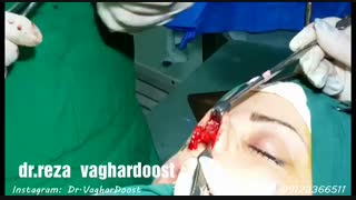 فیلم عمل زیبایی بینی (دکتر رضا وقردوست)( پارت 4)